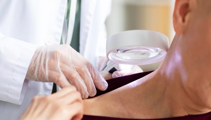 Vacina personalizada contra melanoma avança em testes e reduz risco de retorno do câncer